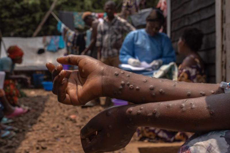 mpox afrique