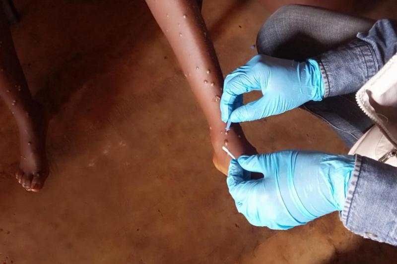 mpox afrique